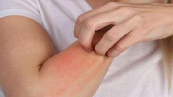 حساسية الجلد.. أعراضها وأنواعها وعلاجاتها