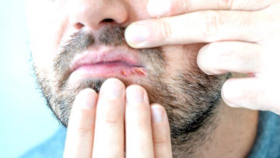 دراسة تُحذرمن علامة تظهر داخل الفم لدى 70٪ من حالات الاصابة بـ”جدري القردة”!
